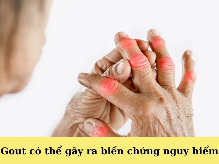 Những biến chứng nguy hiểm của bệnh gout bien chung gout bia