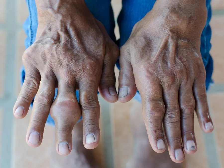 Bệnh gout có những biểu hiện như thế nào? bien dang khop