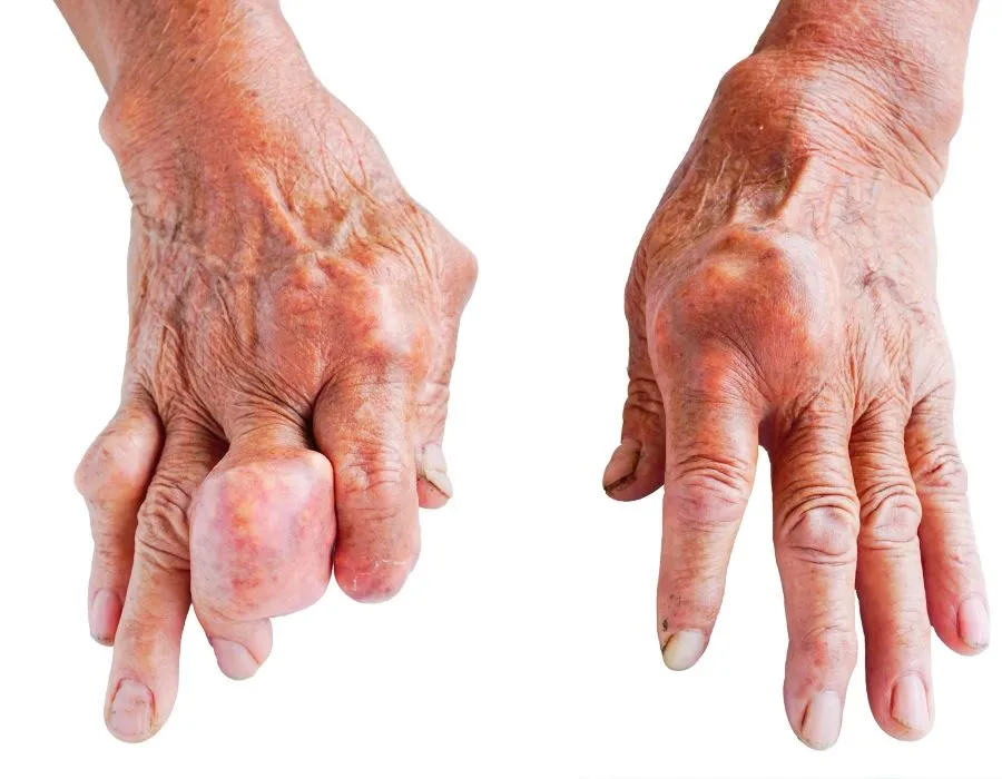 Cách chữa gút tại nhà đơn giản với Hà Thống Phong chua gout tai nha