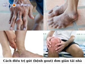 Hinh Nen Dieu Tri Gout Tai Nha