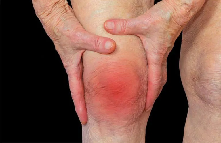 Sưng Khớp do Tràn Dịch Khớp sung dau goi