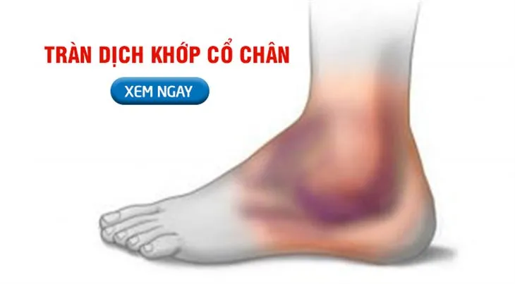 Tran Dich Khop Co Chan